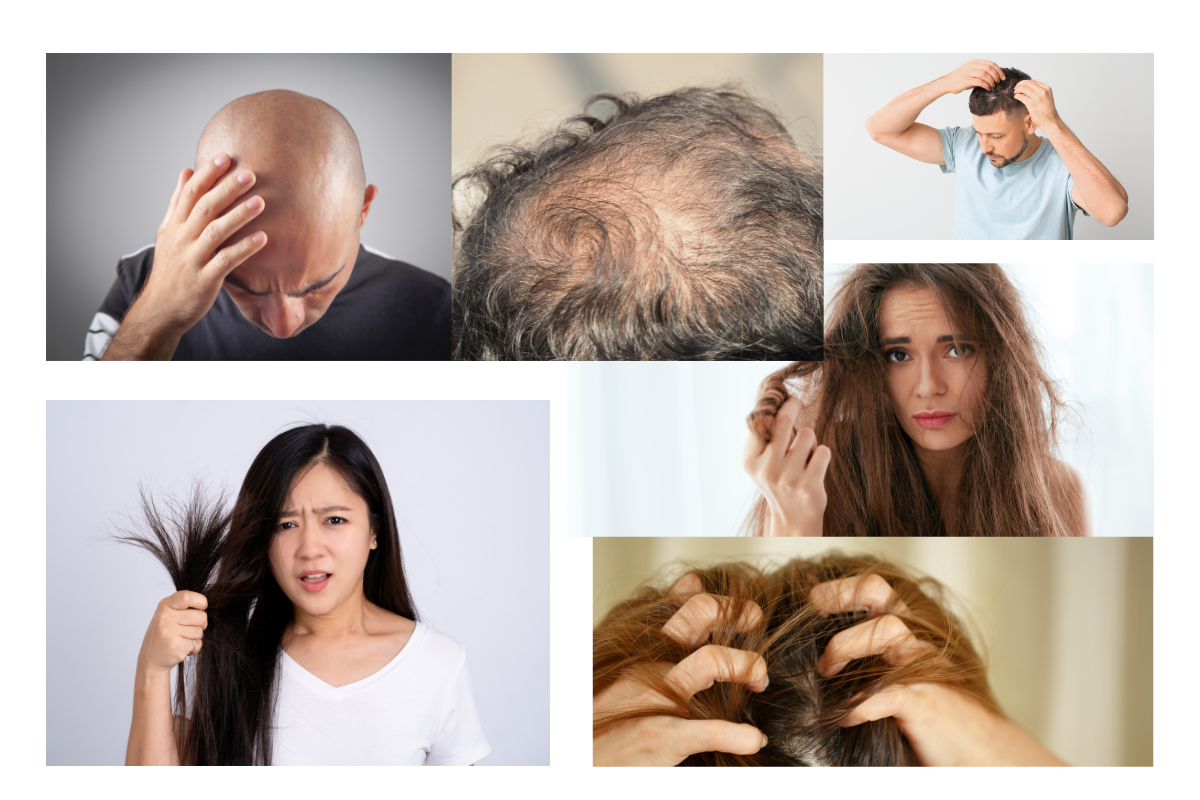 people suffering from different types of hair problems: hair fall, dandruff, thin hair, alopecia , split hair