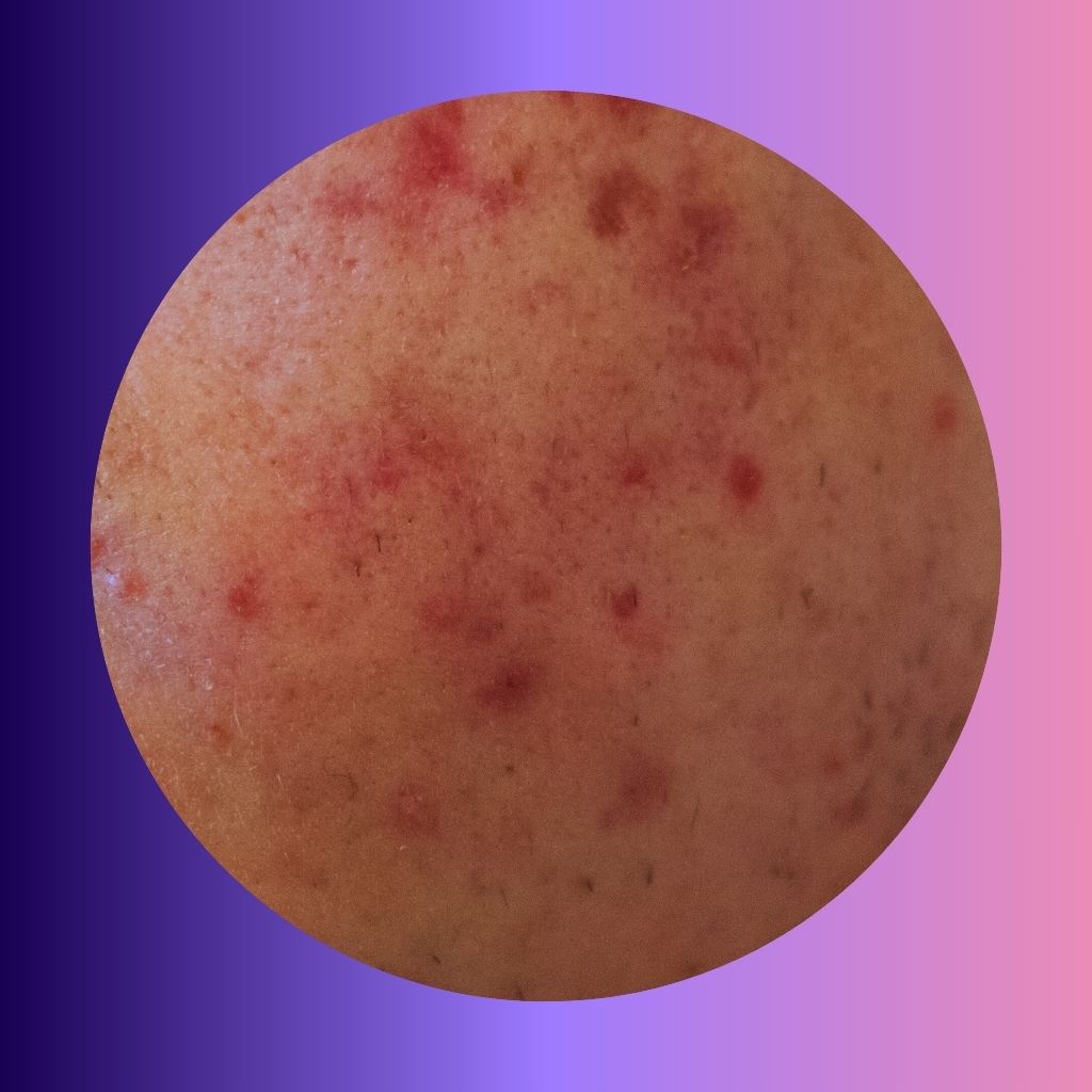 Acne, pimples, whiteheads, black heads