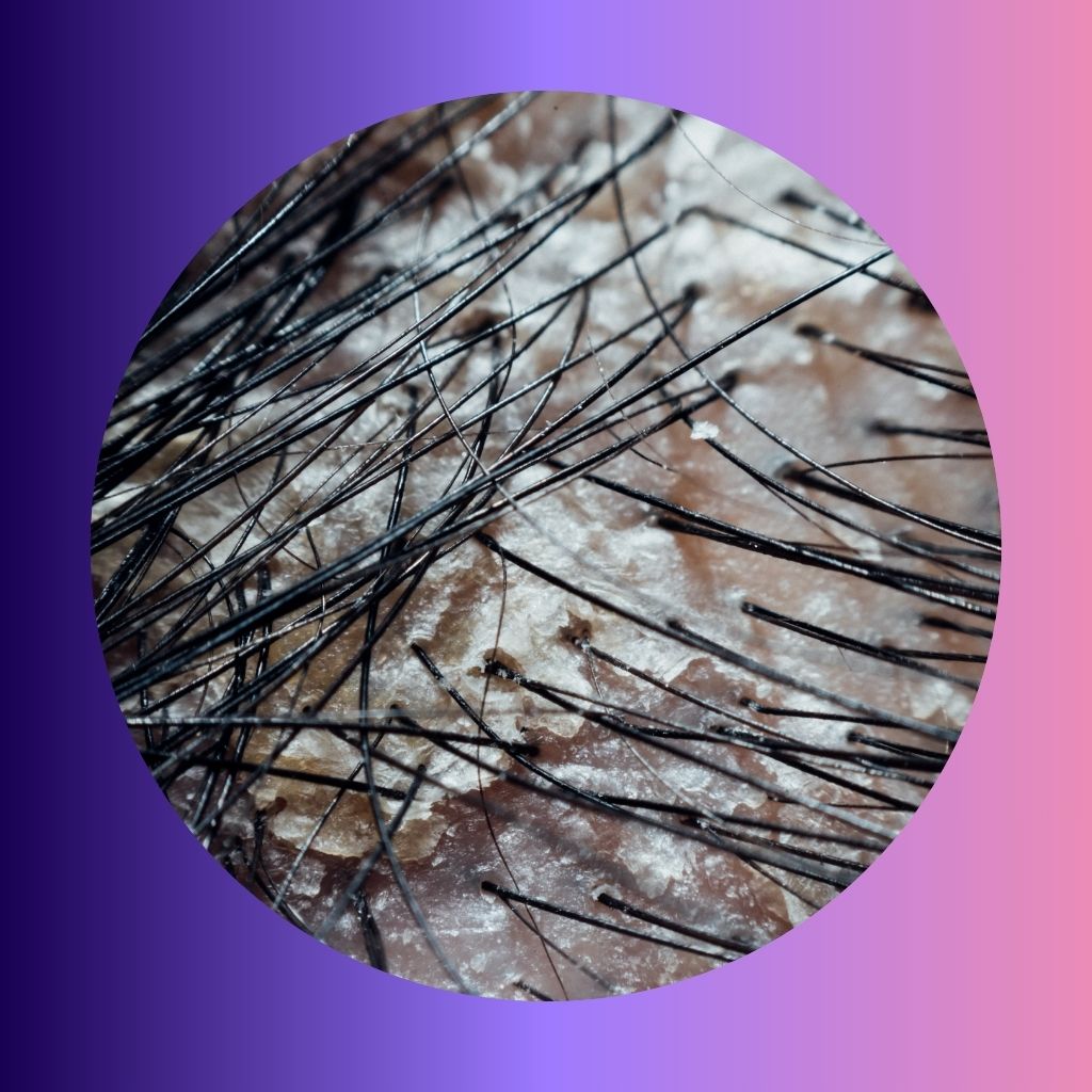 Dandruff & Scalp issues