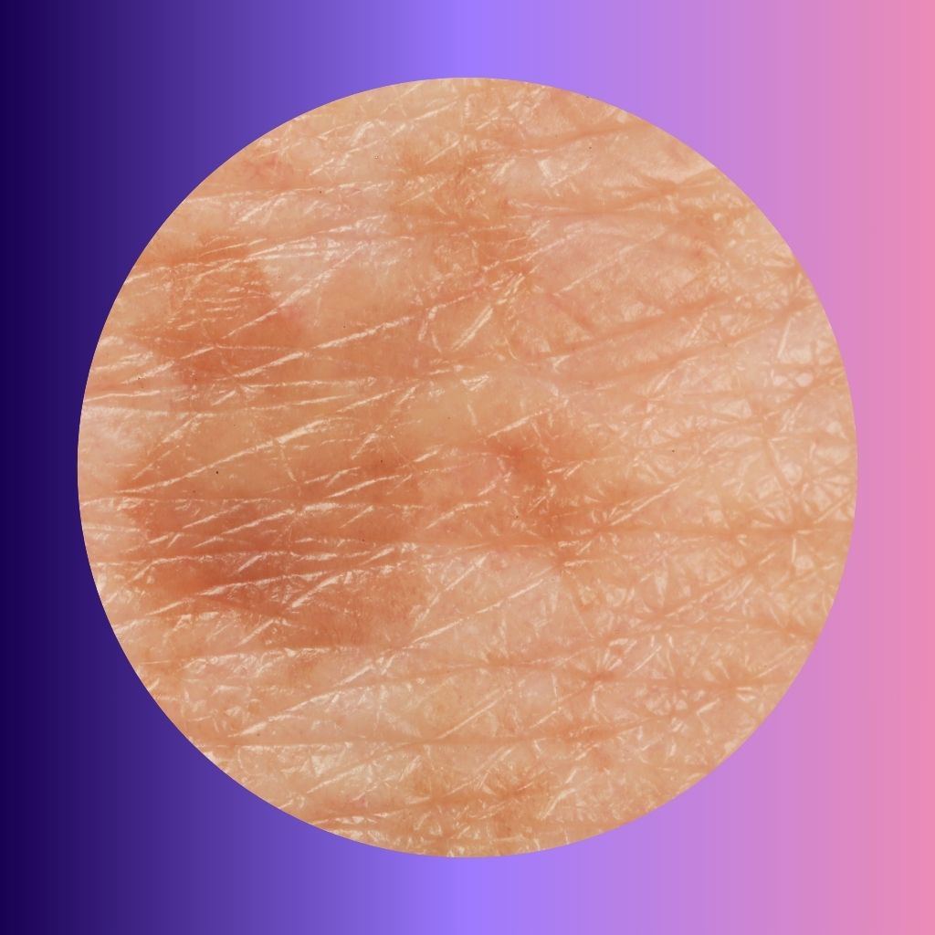 Hyperpigmentation